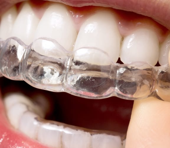 Clear aligner being put on the upper teeth